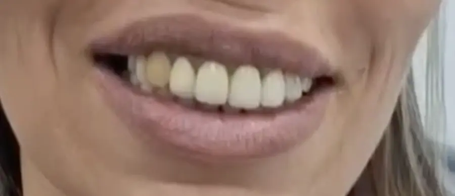 2025-07-30-9.24.03-ezgif.com-resize לפני ואחרי