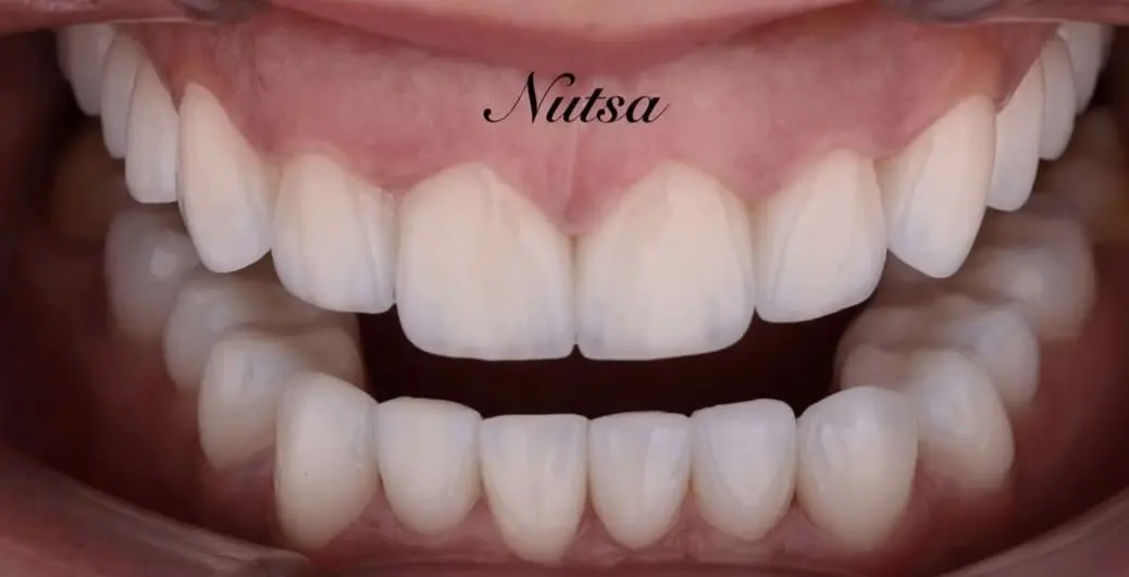 514594244_24278829141752943_3415278556572232036_n-ezgif.com-crop-1 לפני ואחרי