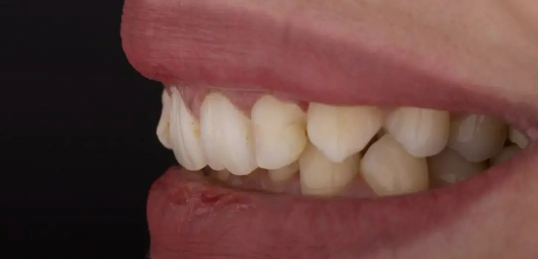 514915358_24278835881752269_4156313006875190314_n-ezgif.com-crop-1 לפני ואחרי