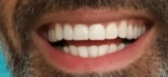 WhatsAppImage2025-07-30at07.08.31-ezgif.com-crop לפני ואחרי