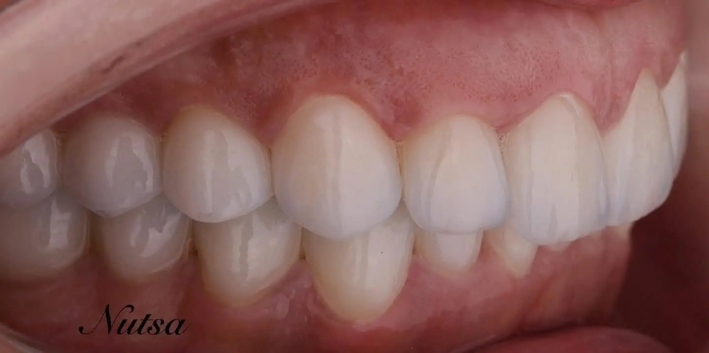 1-ezgif.com-crop לפני ואחרי