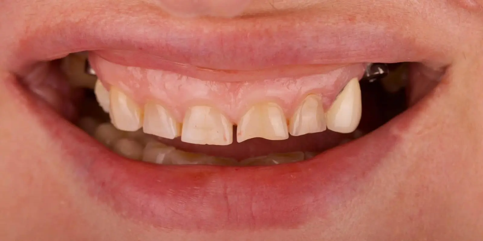 10-ezgif.com-crop לפני ואחרי