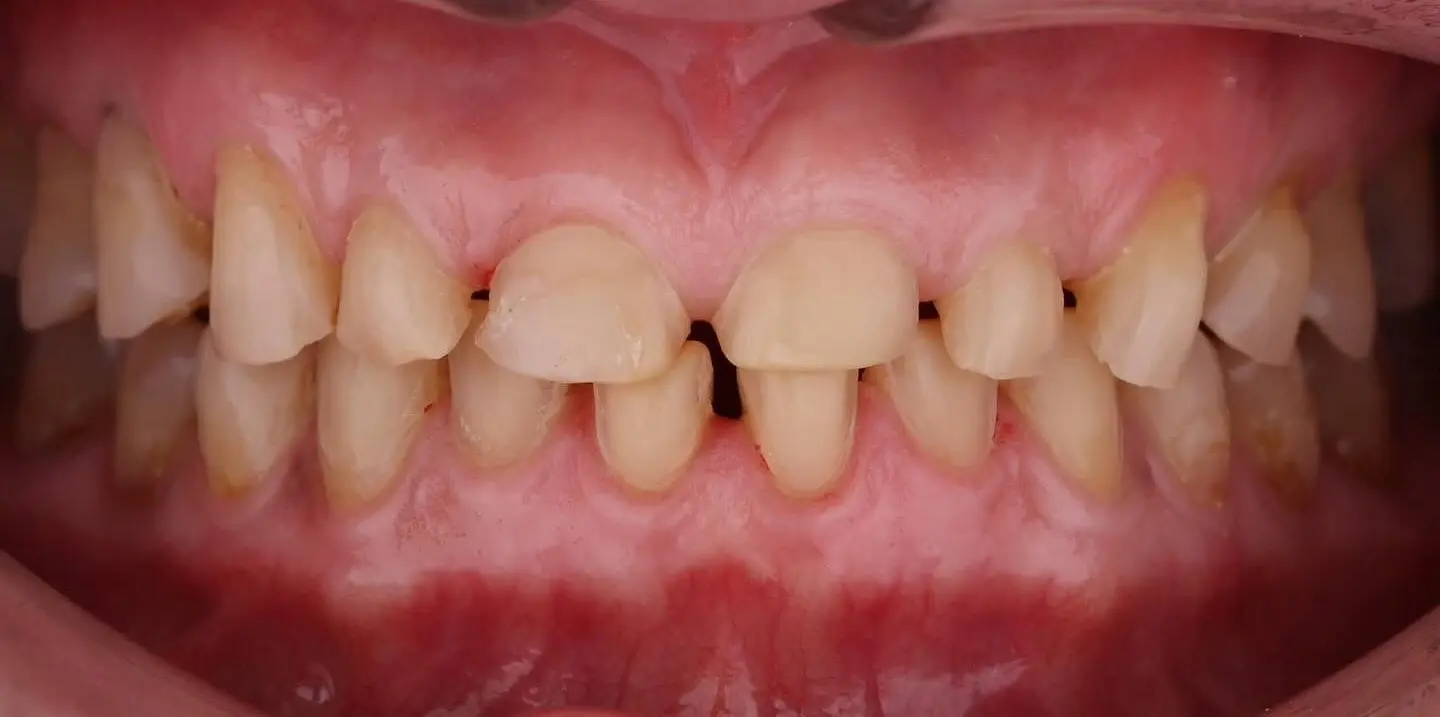 2-ezgif.com-crop-1 לפני ואחרי