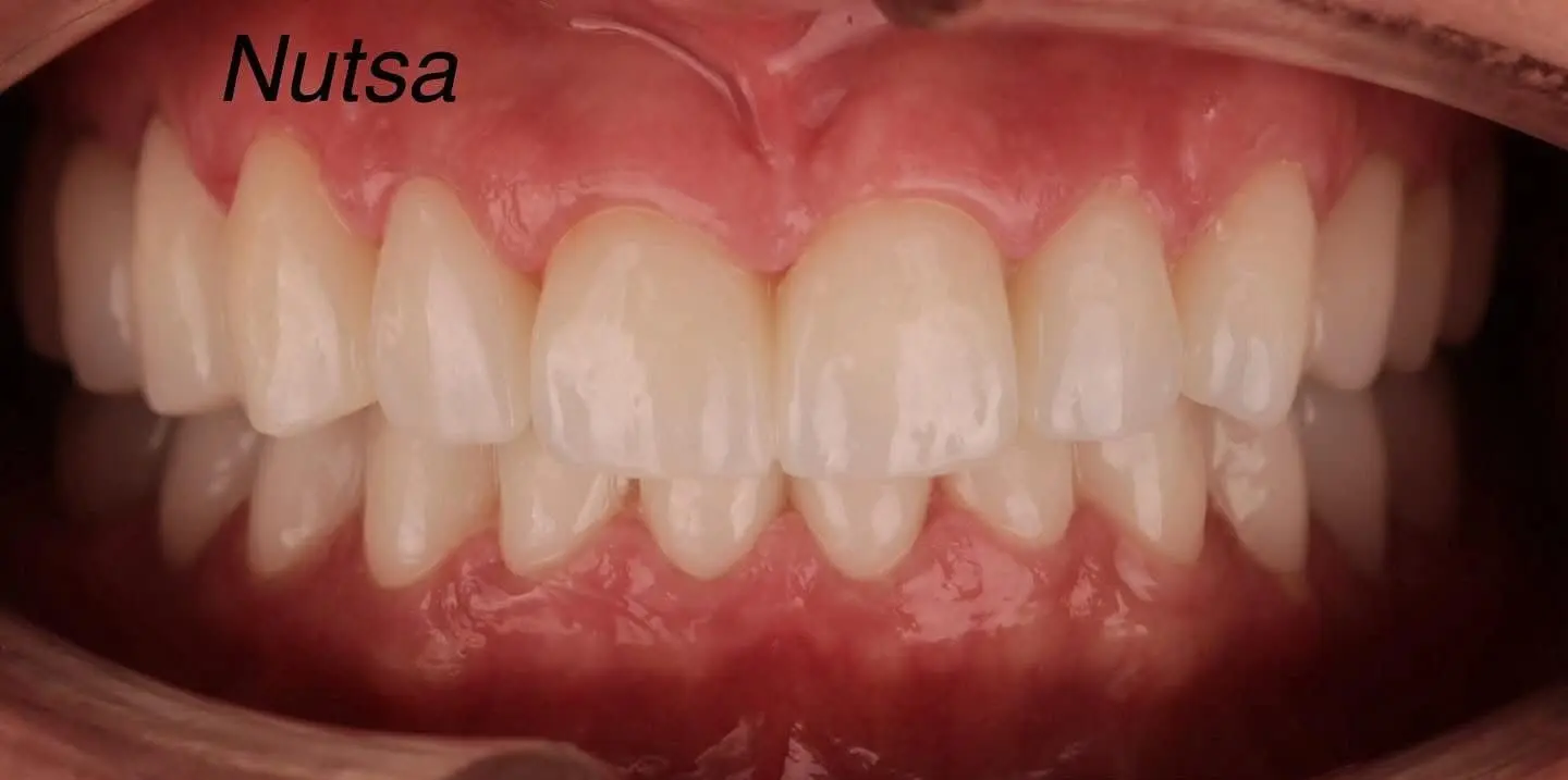 2-ezgif.com-crop לפני ואחרי