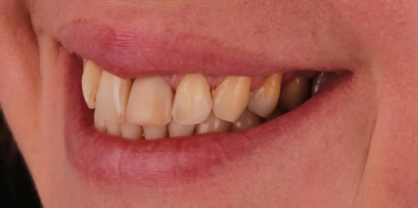 3-ezgif.com-crop-1 לפני ואחרי