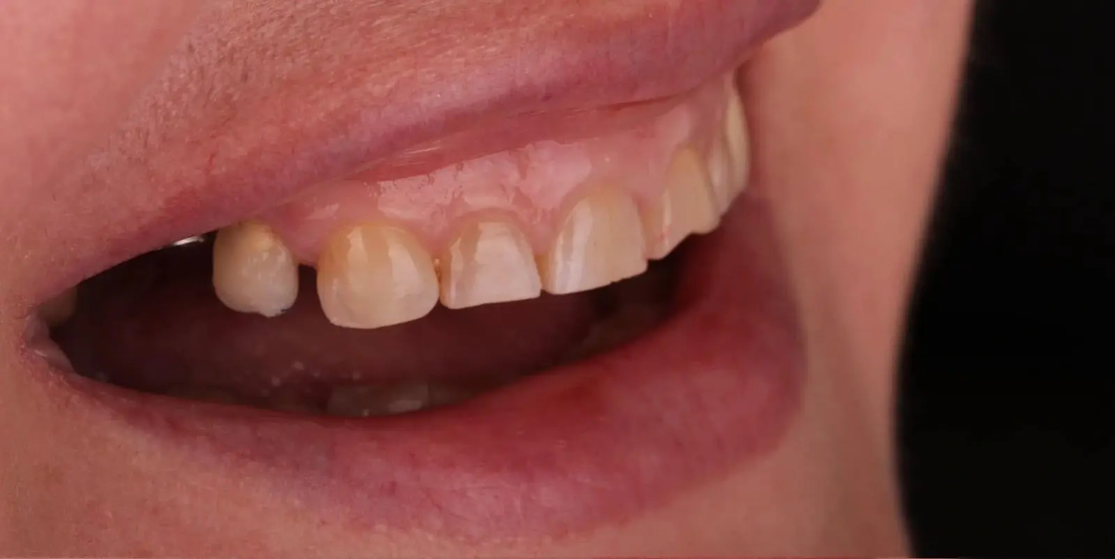 4-ezgif.com-crop לפני ואחרי