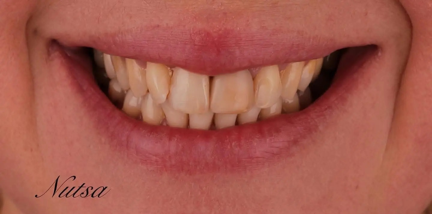 6-ezgif.com-crop לפני ואחרי